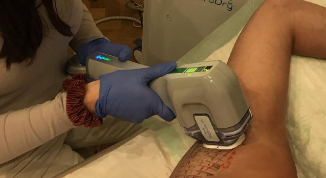 So läuft miraDry® ab