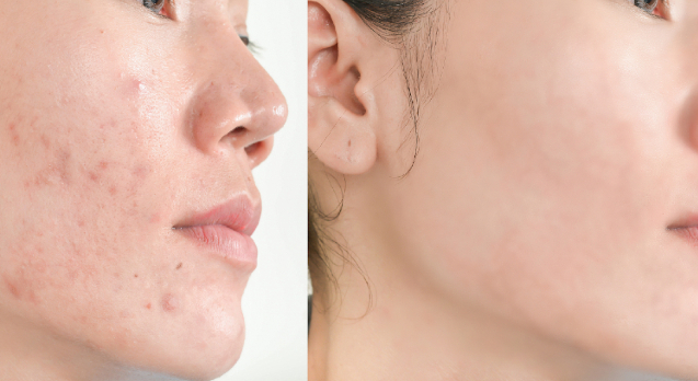 Das gilt es nach der Therapie zu beachten