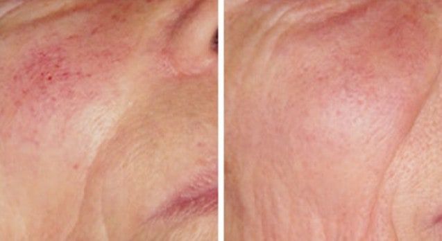 Rosacea Behandlung – die verschiedenen Methoden im Überblick