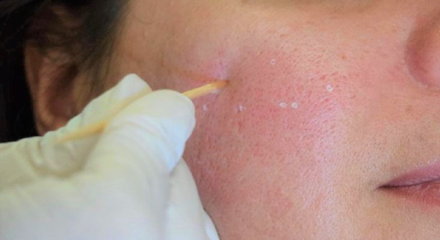 Narbenbehandlung: Mit diesen fünf Therapien lassen sich Narben behandeln