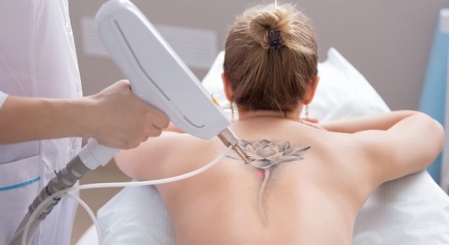 Tattoo mit dem Laser entfernen – Behandlungsverlauf bei der Tattooentfernung in Zürich